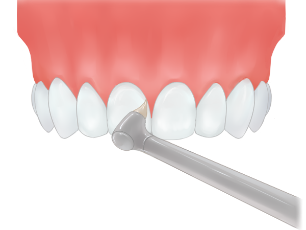 むし歯になる前に予防 盛岡市の歯科 Dental Office K インプラント治療 セラミック治療なら当院へ