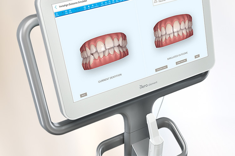 歯型の採取に光学印象機器「iTero」を導入