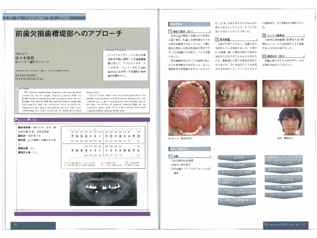 The Journal of SJCD　Vol.1・No.１　2013／前歯欠損歯槽堤部へのアプローチ／平成25年12月24日発行