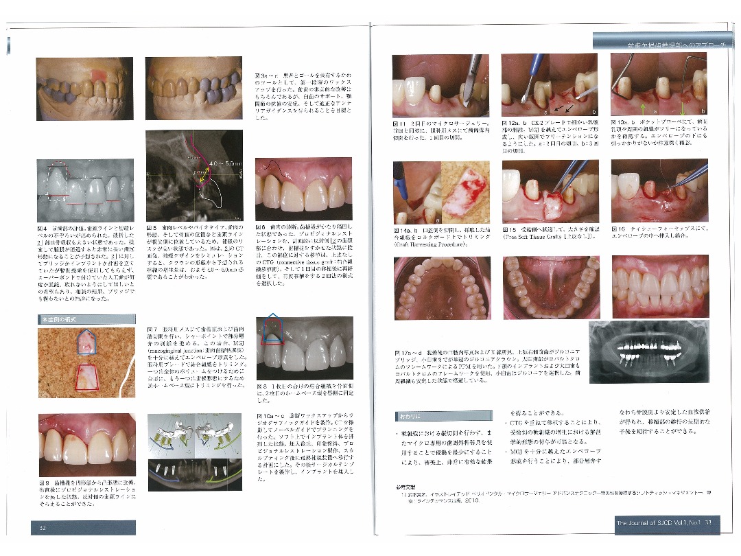 The Journal of SJCD　Vol.1・No.１　2013／前歯欠損歯槽堤部へのアプローチ