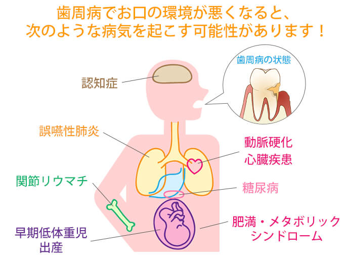 歯周治療 予防 青森県十和田市の歯医者 さつき歯科医院
