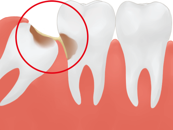 親知らずの抜歯 弘前市にある歯科医院 石岡歯科医院