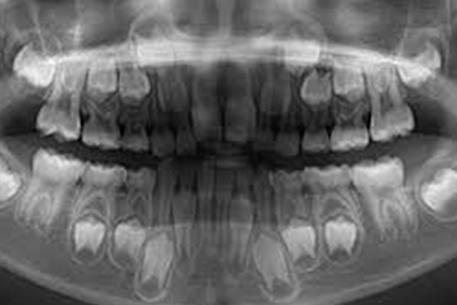 レントゲン 乳歯 小児歯科でのレントゲン撮影が心配！身体への悪影響は？