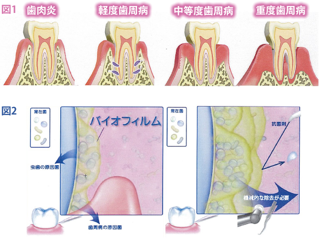 歯周病の原因と進行 山形県東根市の歯医者 森歯科クリニック