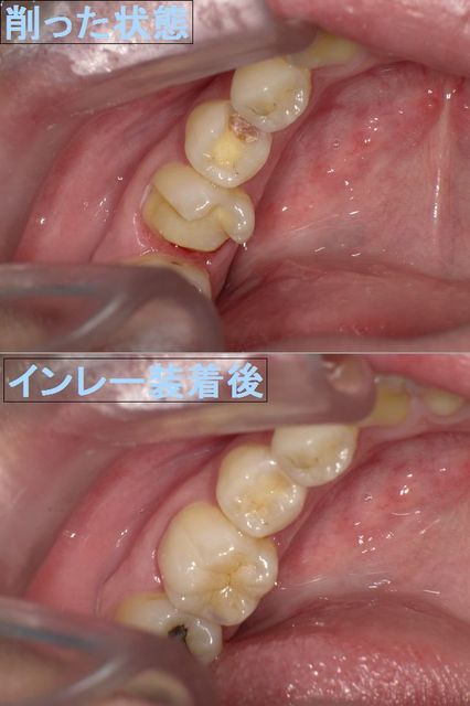 むし歯の治療法(2)