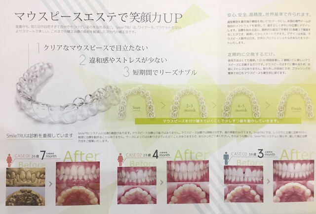 「マウスピース矯正」