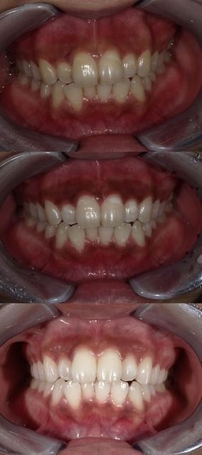 伸びる のどちんこ 口蓋垂が伸びる症状
