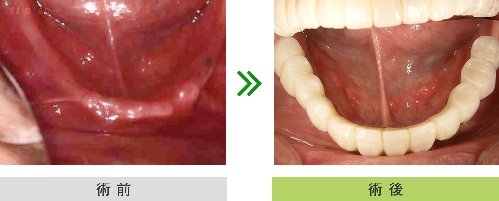 インプラント症例（下顎　全歯）