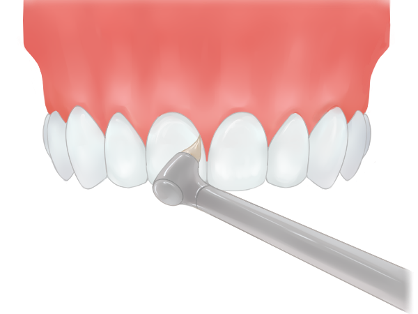 STEP1 チェックと歯間の清掃