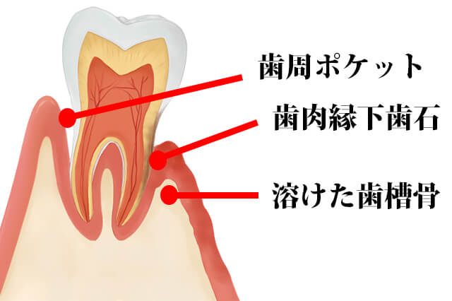 歯周病治療 仙台市太白区茂庭の歯医者 もにわファミリー歯科クリニック