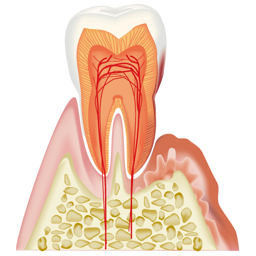 中等度歯周病における歯周外科処置について