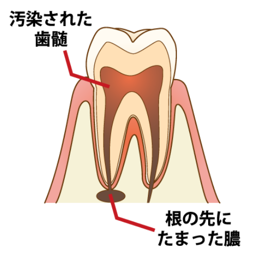 歯内療法 根管治療 仙台市若林区の歯医者 太紀デンタルクリニック