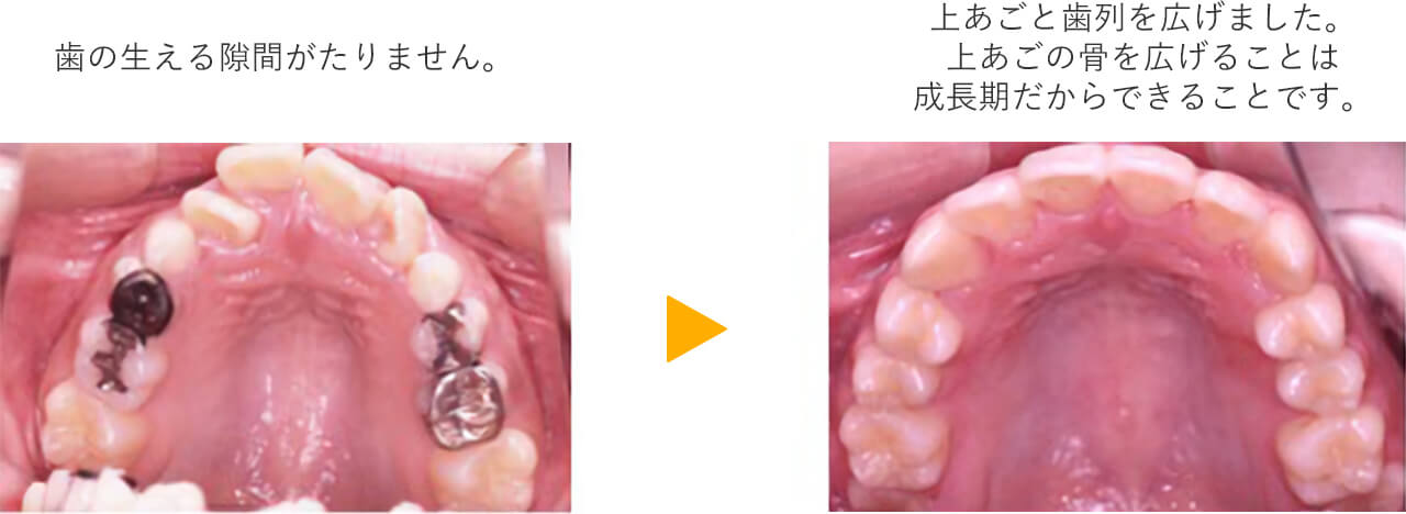 歯の生えるスペースの確保イメージ画像