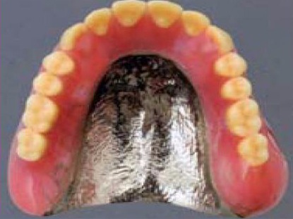 コバルトクロムの総義歯