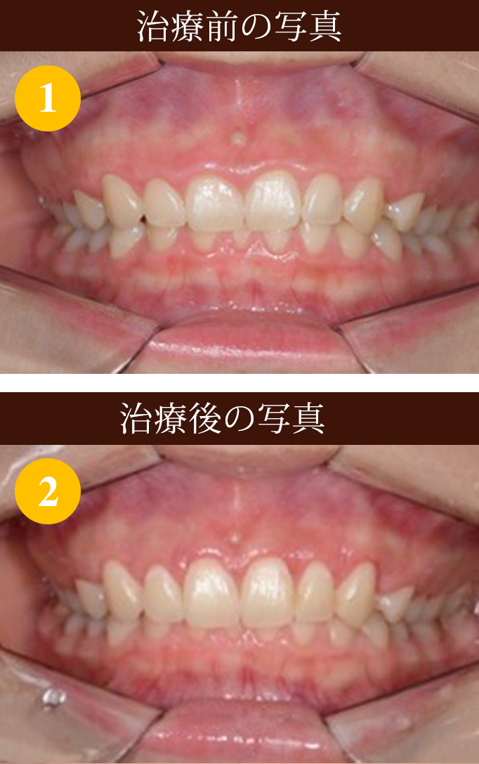 歯周外科 難治療 ② 写真