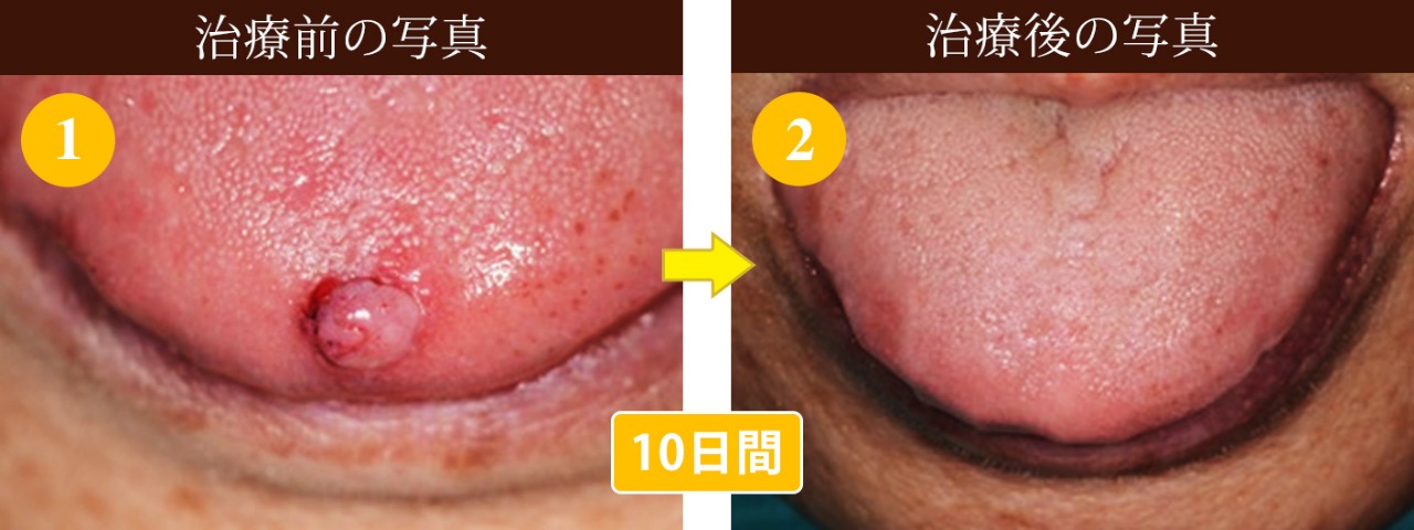舌の腫瘍切除 難治療 写真