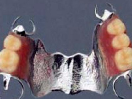 コバルトクロムの部分義歯