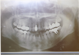 歯牙移植術レントゲン
