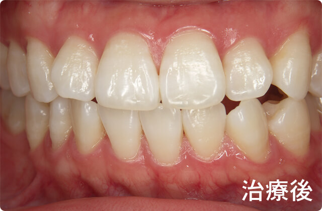 自宅でお気軽ホワイトニング 水戸市にある歯医者 フカヤ歯科クリニック