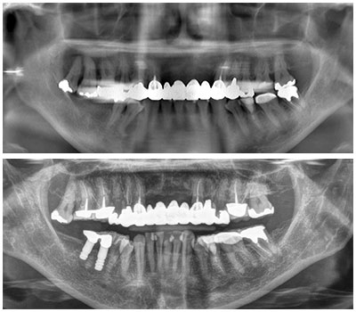 インプラント症例集 福島県郡山市 うすい歯科医院