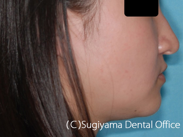噛み合わせ治療症例 仙台市青葉区の歯科医院 杉山歯科医院
