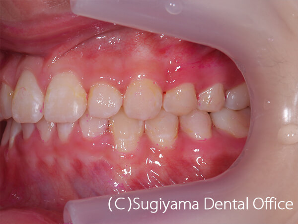 抜歯をしない矯正治療症例 仙台市青葉区の歯科医院 杉山歯科医院