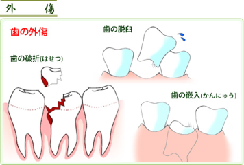 歯の外傷 ケガ について 歯合わせブログ 仙台市青葉区南吉成の歯科医院 まさみ歯科