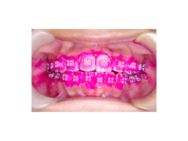 虫歯、歯周病予防処置について