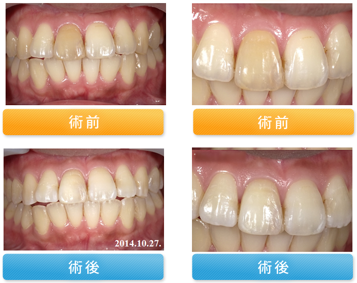 ホワイトニングの症例 桂歯科クリニック