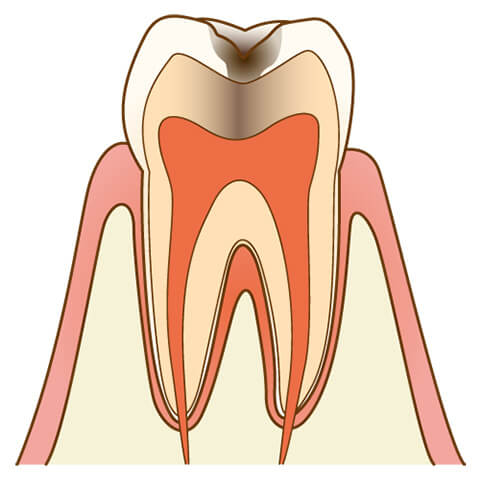 虫歯治療 仙台市若林区土樋の歯医者 愛宕橋駅から徒歩3分 はるみ歯科