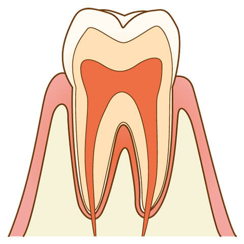 虫歯治療 仙台市若林区土樋の歯医者 愛宕橋駅から徒歩3分 はるみ歯科