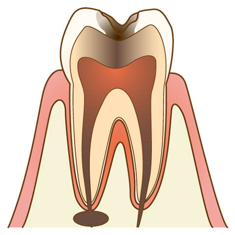 虫歯治療 仙台市若林区土樋の歯医者 愛宕橋駅から徒歩3分 はるみ歯科