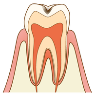 むし歯（C1）の歯の断面図