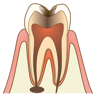 むし歯（C3）の歯の断面図